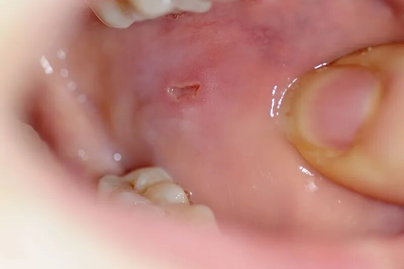 长期炎症会”唤醒“癌细胞! 出现这些症状要当心, 这份抗炎指南请收好 长期炎症会”唤醒“癌细胞! 出现这些症状要当心, 这份抗炎指南请收好