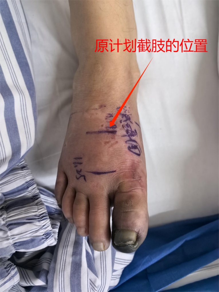 只是脚冷而已，浙江30多岁男子却险遭截肢！很多人都在犯同样错