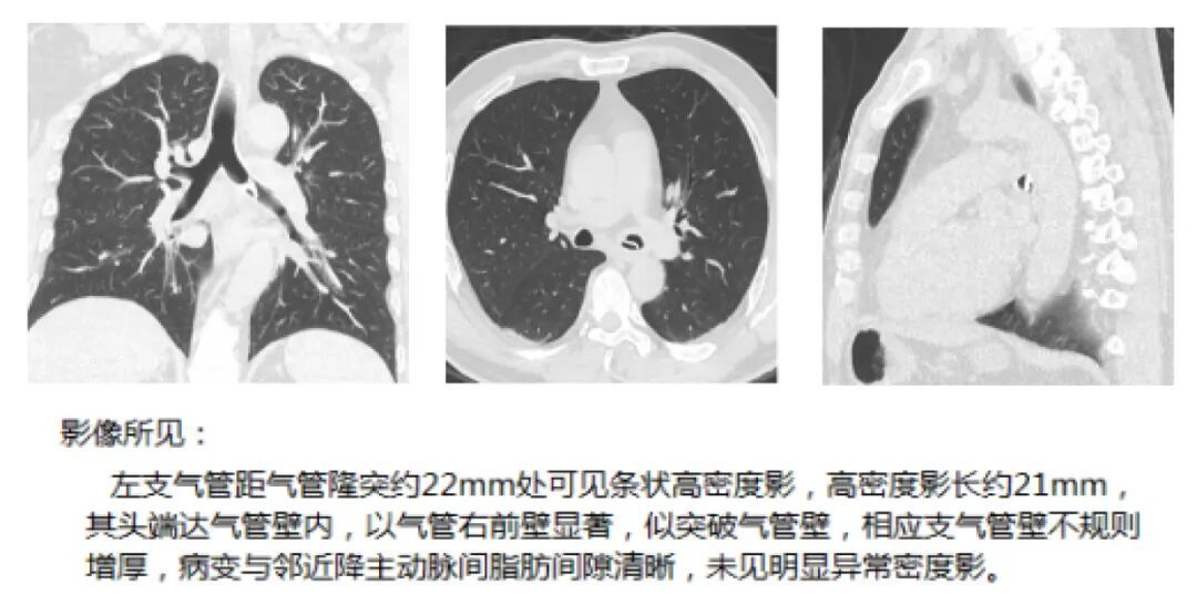河南57岁男子聚餐喝酒后咳血进ICU,医生提醒:饭桌上这些习惯要避免 河南57岁男子聚餐喝酒后咳血进ICU,医生提醒:饭桌上这些习惯要避免