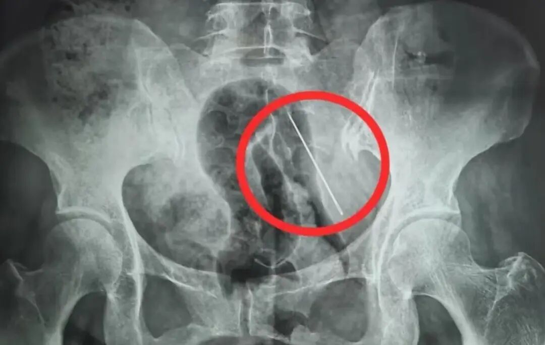 60岁奶奶抱孙子玩耍,腰间4厘米钢针扎进肚子! 60岁奶奶抱孙子玩耍,腰间4厘米钢针扎进肚子!