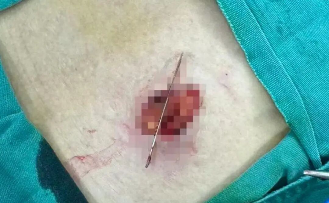 60岁奶奶抱孙子玩耍,腰间4厘米钢针扎进肚子! 60岁奶奶抱孙子玩耍,腰间4厘米钢针扎进肚子!