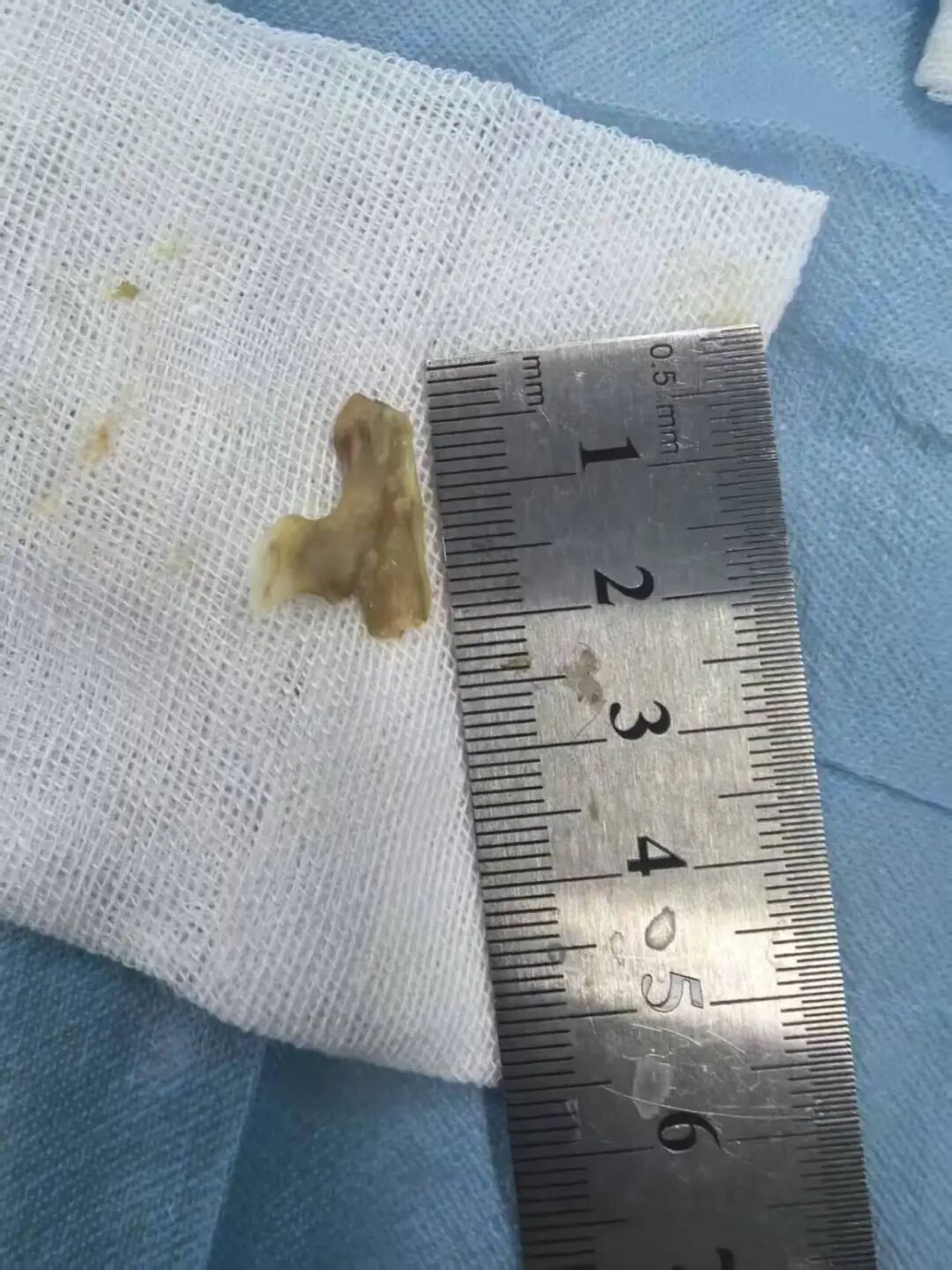 河南57岁男子聚餐喝酒后咳血进ICU,医生提醒:饭桌上这些习惯要避免 河南57岁男子聚餐喝酒后咳血进ICU,医生提醒:饭桌上这些习惯要避免