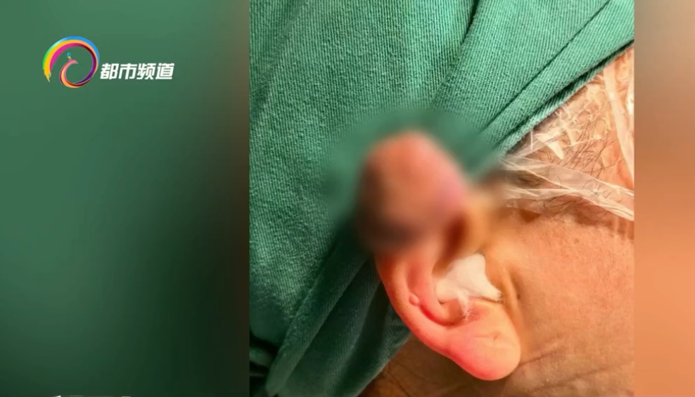 打耳洞长出“肉疙瘩”?医生道出真相,同时提醒:这些人群要小心! 打耳洞长出“肉疙瘩”?医生道出真相,同时提醒:这些人群要小心!