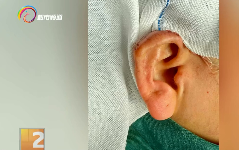 打耳洞长出“肉疙瘩”?医生道出真相,同时提醒:这些人群要小心! 打耳洞长出“肉疙瘩”?医生道出真相,同时提醒:这些人群要小心!