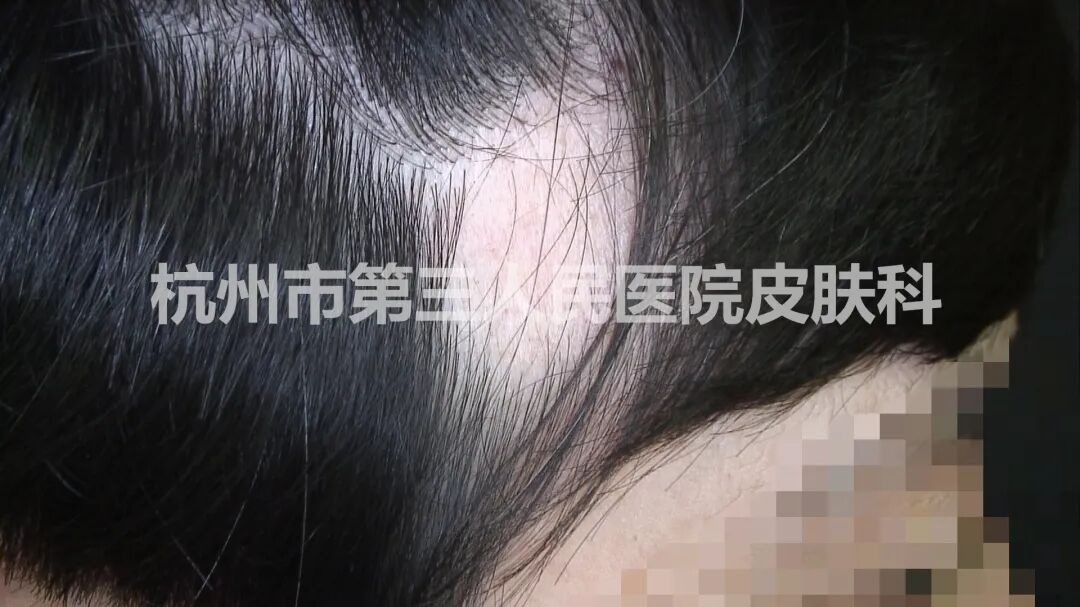 一夜之间头上秃了？浙江24岁小伙半个脑袋的头发，都掉光了…这个坏习惯很多人都有