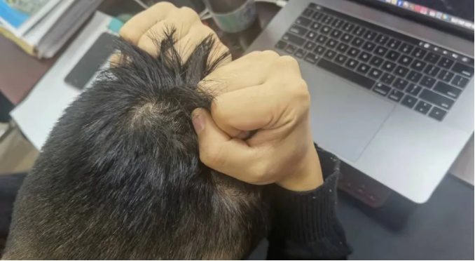 一夜之间头上秃了？浙江24岁小伙半个脑袋的头发，都掉光了…这个坏习惯很多人都有