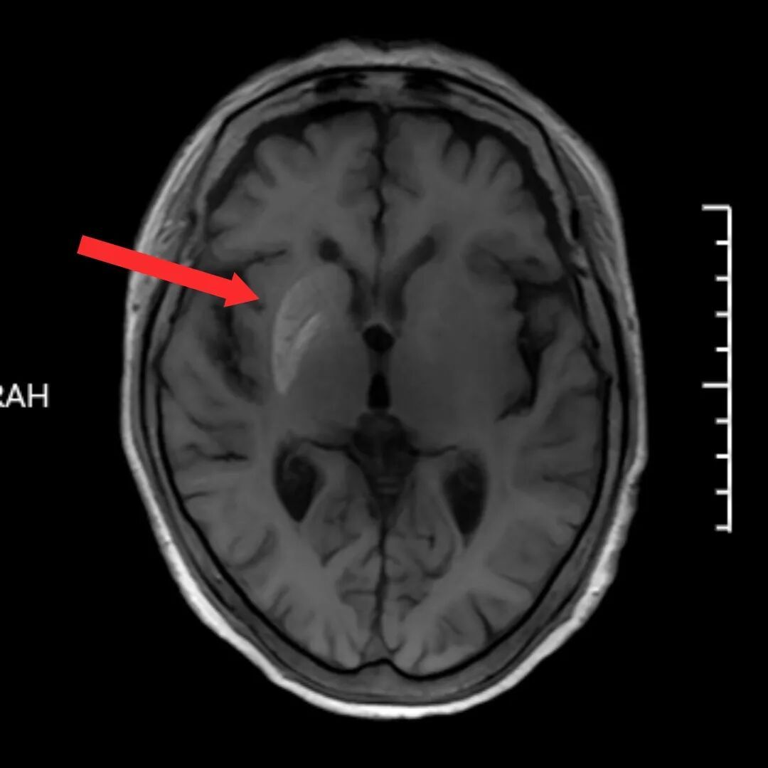 怪事!浙江一奶奶手臂“自己跳舞”!没想到是…医生:务必警惕这指标 怪事!浙江一奶奶手臂“自己跳舞”!没想到是…医生:务必警惕这指标