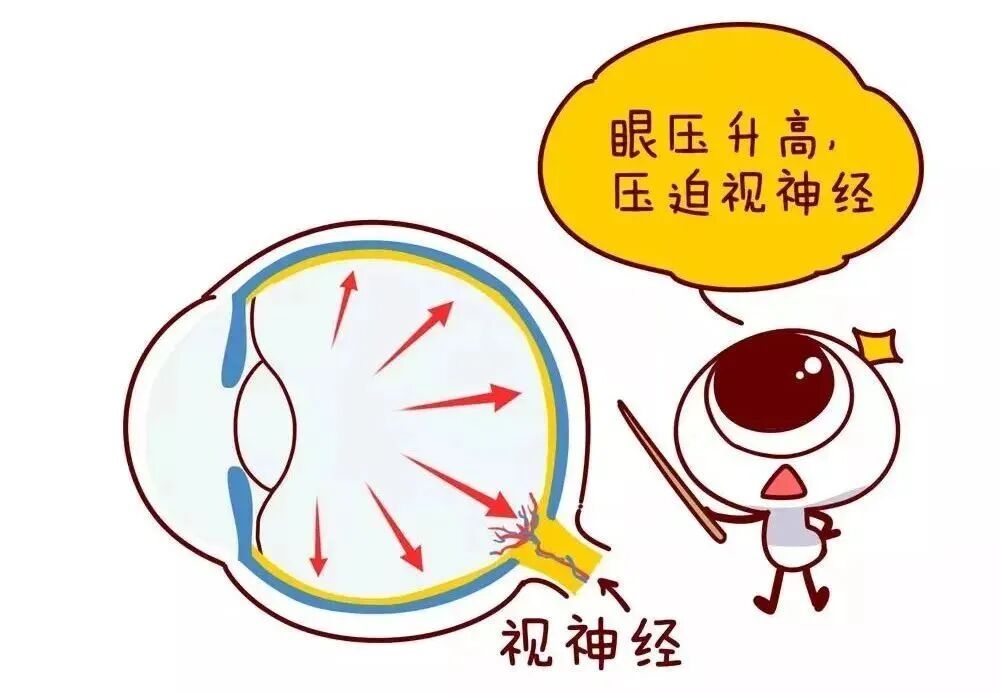 40岁后必看！这5类人最容易被青光眼盯上→