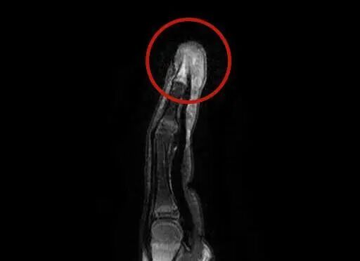 轻轻一碰就钻心疼！医生：再晚一点就要截指了