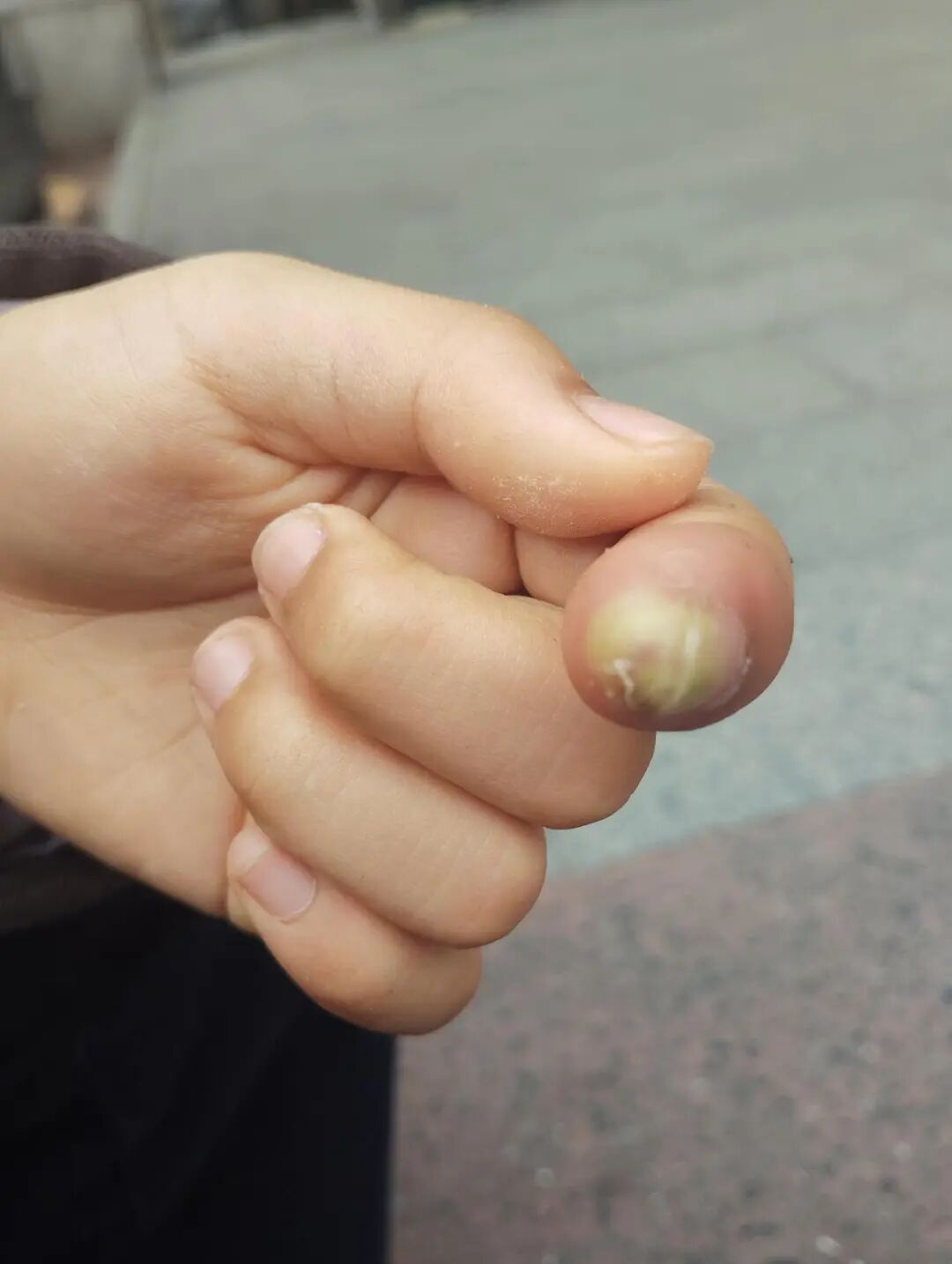 轻轻一碰就钻心疼！医生：再晚一点就要截指了