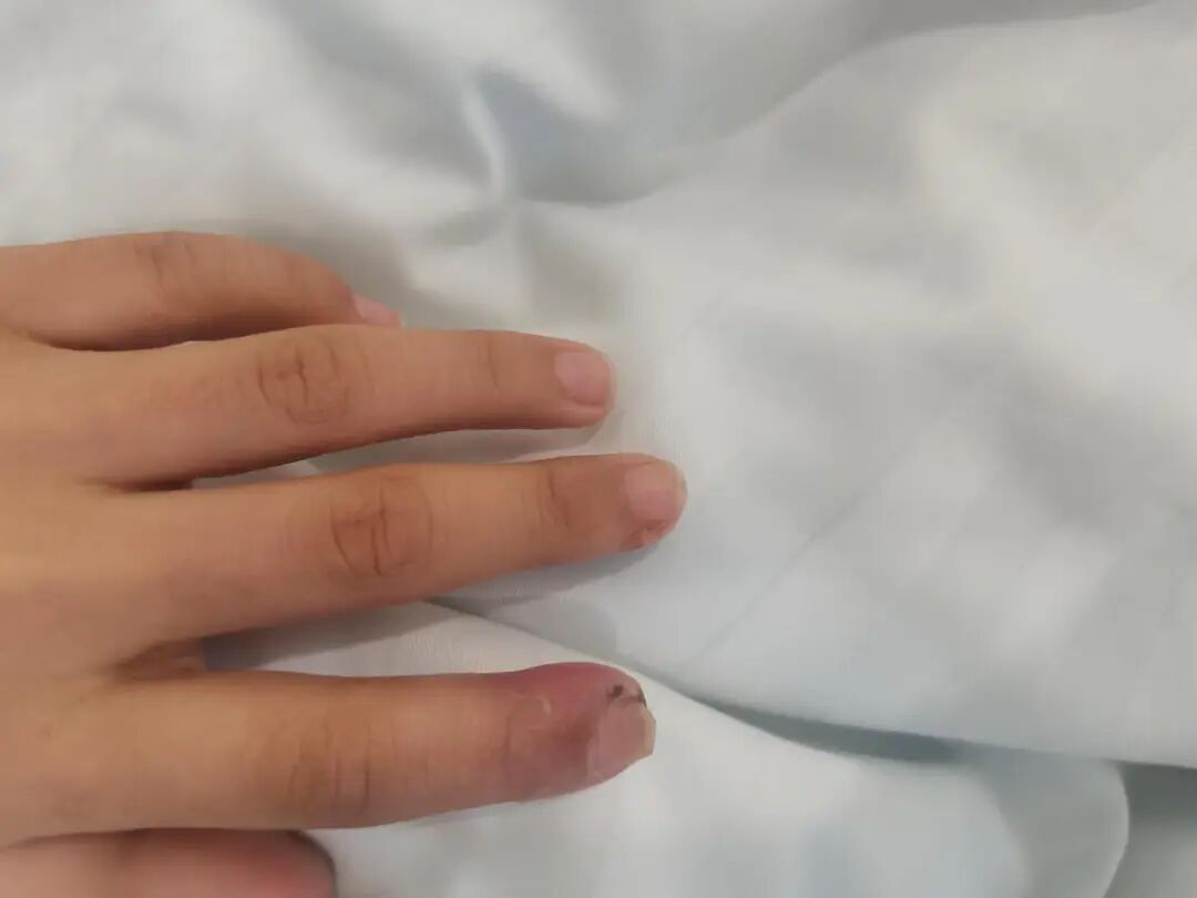 轻轻一碰就钻心疼！医生：再晚一点就要截指了