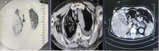 25岁海南小伙糖尿病进ICU！历经17天生死抢救，康复后他做了这件事→