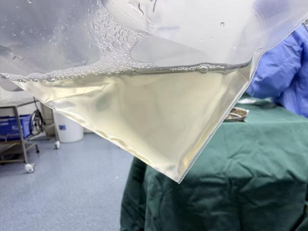 脖子上长了个不痛不痒的“水馒头”，一年后竟然掉进胸腔！