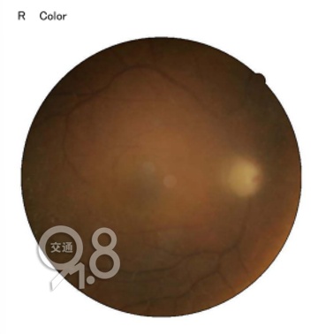 警惕“无声的视力小偷”！37岁女子两年内视力从1.0变近乎失明