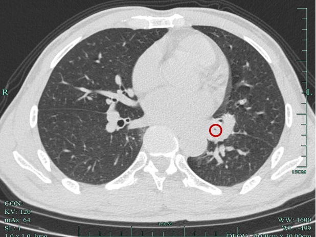 咳嗽二十多年，天一冷就犯！CT一查，这里被堵死了