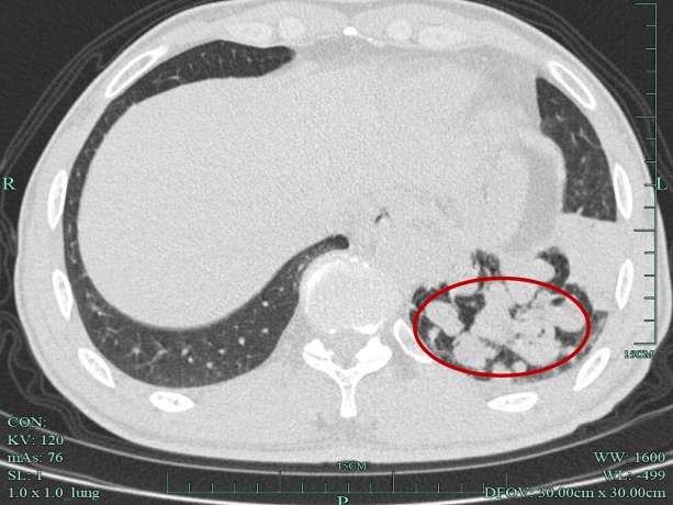 咳嗽二十多年，天一冷就犯！CT一查，这里被堵死了