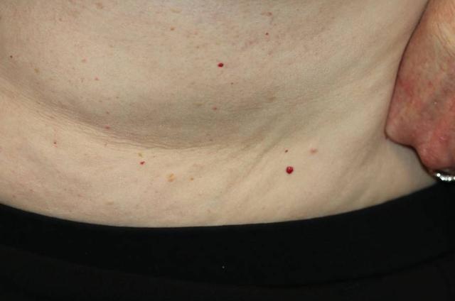 身上突然长的小红点，到底是什么？会癌变吗？