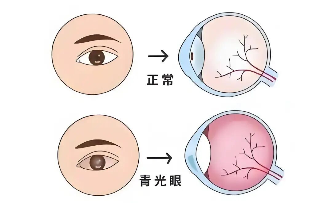 警惕“无声的视力小偷”！37岁女子两年内视力从1.0变近乎失明