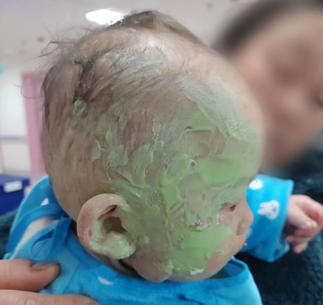 1岁婴儿翻入火盆致面部烧伤，家长用“土方子” 涂满牙膏！医生：错误行为