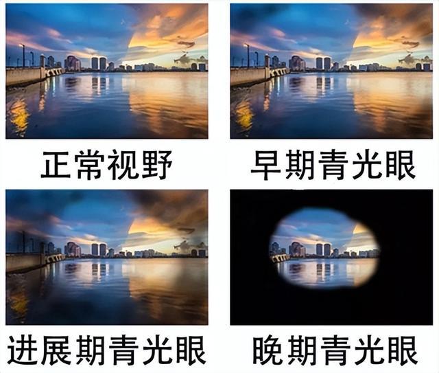 有这个习惯，小心青光眼损伤你的视力