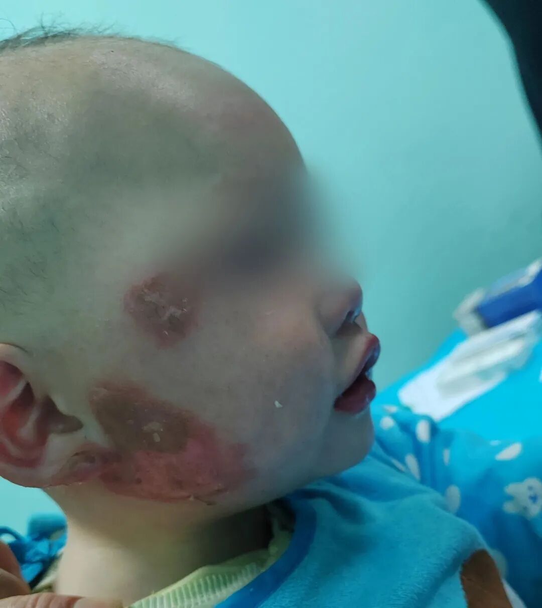 1岁婴儿翻入火盆致面部烧伤，家长用“土方子” 涂满牙膏！医生：错误行为
