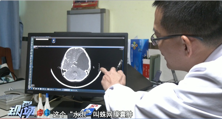 6岁半男童仅会说单字，竟是因为大脑被“水泡”占据四分之一