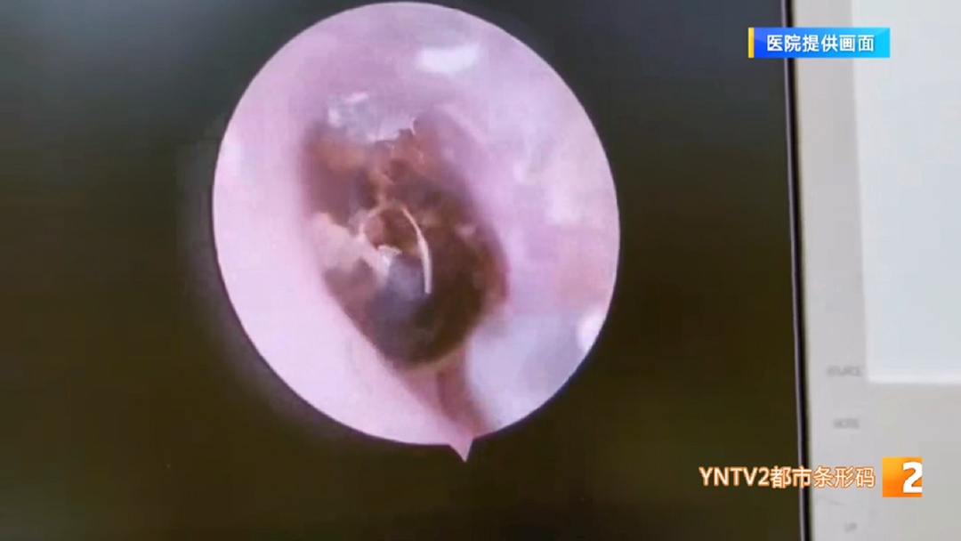 不停蠕动!嗡嗡作响!昆明一男子赏花时,蜜蜂钻进左耳…… 不停蠕动!嗡嗡作响!昆明一男子赏花时,蜜蜂钻进左耳……