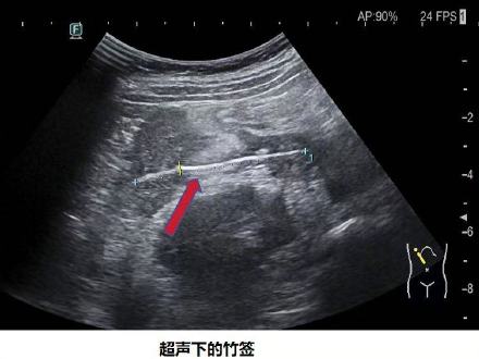 男孩吃鸡柳误食竹签刺破脏器