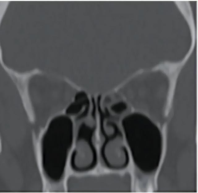 经常挖鼻孔，后来都怎么样了？有这种情况的人真的要注意了