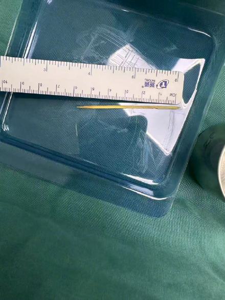 男孩吃鸡柳误食竹签刺破脏器