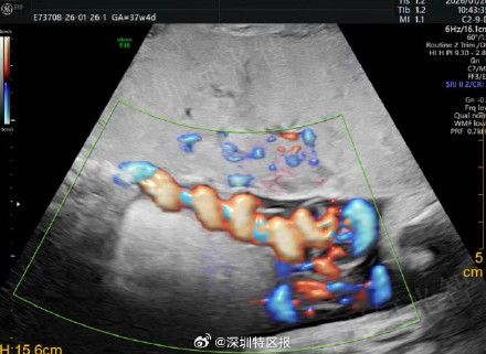 罕见!深圳一胎儿脐带螺旋拧成麻花 罕见!深圳一胎儿脐带螺旋拧成麻花