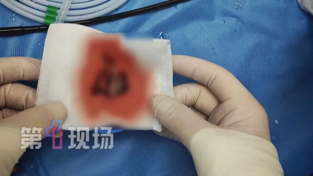 一根输液管差点要了命!静脉被血栓和细菌完全堵死,医生成功“拆弹”救命 一根输液管差点要了命!静脉被血栓和细菌完全堵死,医生成功“拆弹”救命