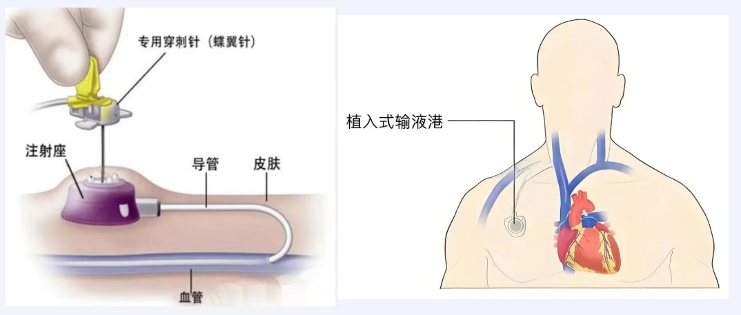 一根输液管差点要了命!静脉被血栓和细菌完全堵死,医生成功“拆弹”救命 一根输液管差点要了命!静脉被血栓和细菌完全堵死,医生成功“拆弹”救命
