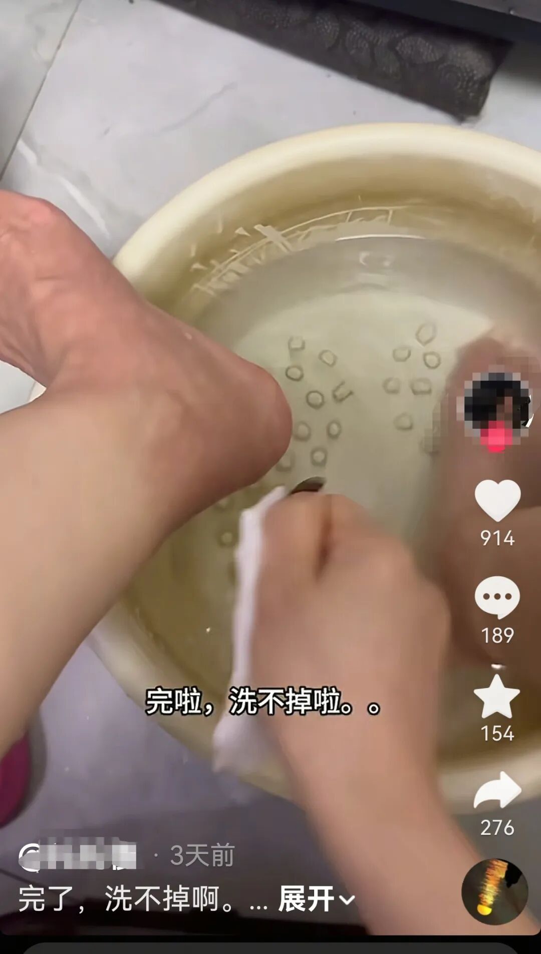 女子用中药包泡脚3个月，以为脚被染色狂搓仍洗不干净，原因竟是……