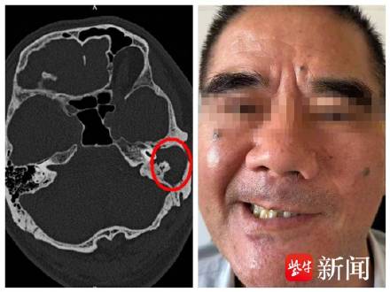 男子闭眼很费力一笑嘴就歪 &nbsp;以为是中耳炎没想到是个瘤