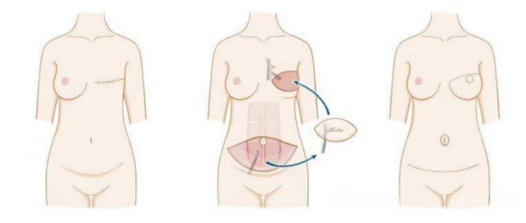 肚子上的肉肉立大功!女子患乳腺癌,医生从腹部"借回"一对新乳房 肚子上的肉肉立大功!女子患乳腺癌,医生从腹部"借回"一对新乳房