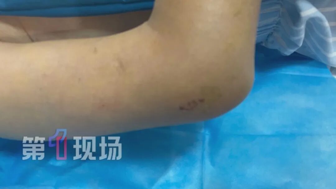 一根输液管差点要了命!静脉被血栓和细菌完全堵死,医生成功“拆弹”救命 一根输液管差点要了命!静脉被血栓和细菌完全堵死,医生成功“拆弹”救命