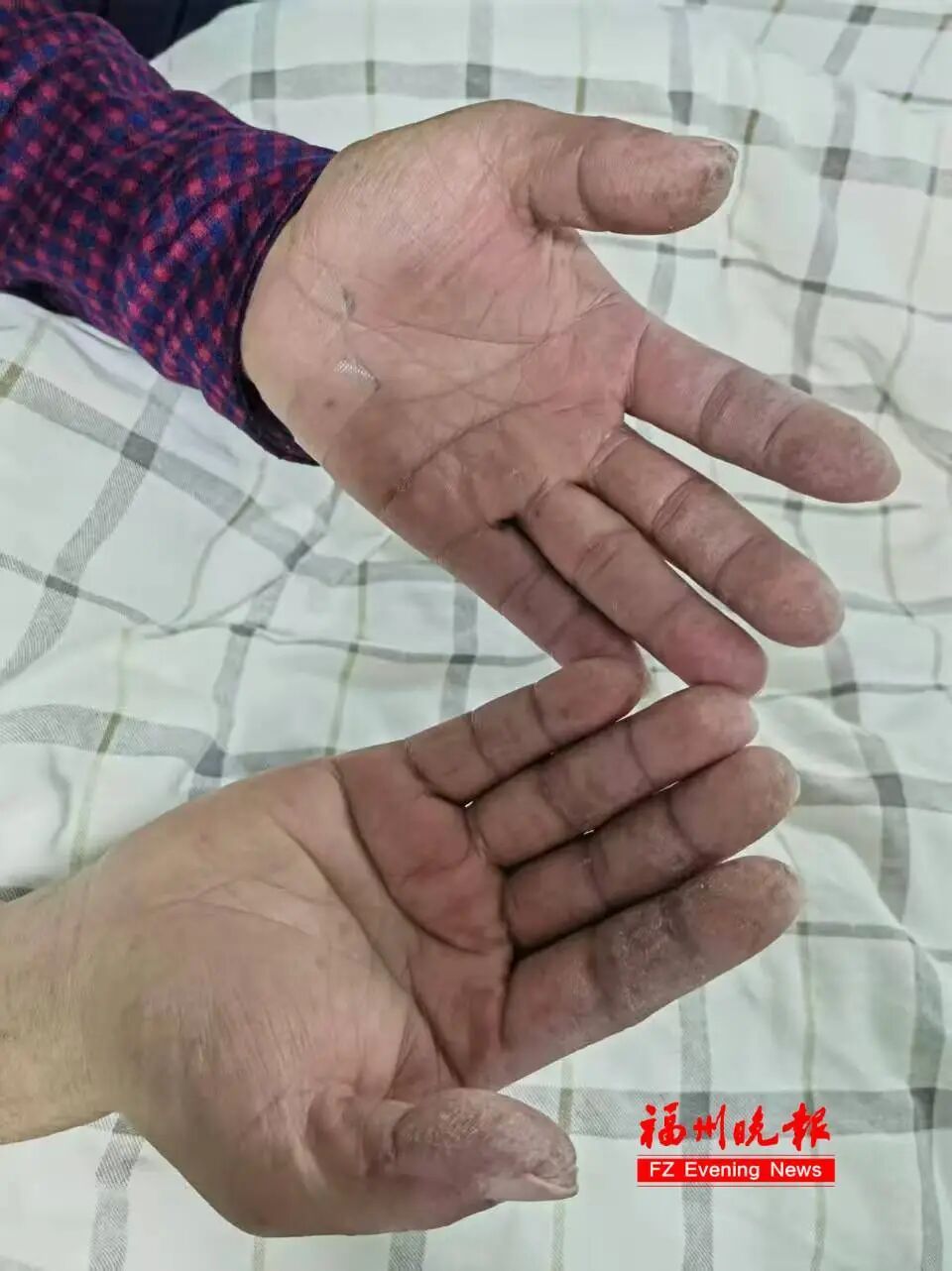 两大妈惊现“技工手”,确诊“假肺炎”,差点没命!福州医生提醒 两大妈惊现“技工手”,确诊“假肺炎”,差点没命!福州医生提醒