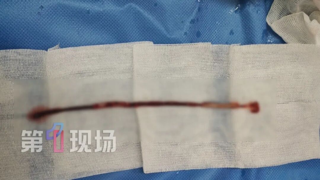 一根输液管差点要了命!静脉被血栓和细菌完全堵死,医生成功“拆弹”救命 一根输液管差点要了命!静脉被血栓和细菌完全堵死,医生成功“拆弹”救命