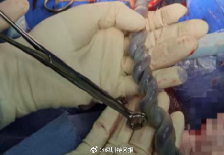 罕见!深圳一胎儿脐带螺旋拧成麻花 罕见!深圳一胎儿脐带螺旋拧成麻花