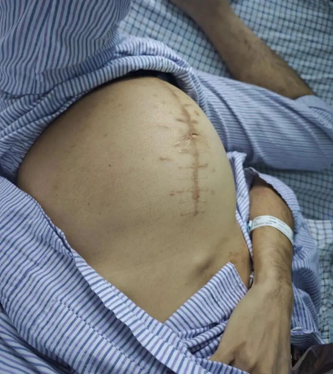 男子肚大如“怀孕”，赴佛山“卸货”20斤肿瘤！医生警告：药不能停！