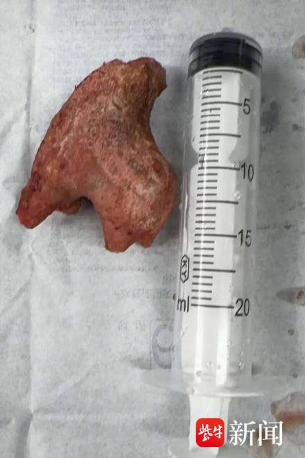 女子肾脏长巨大鹿角形结石