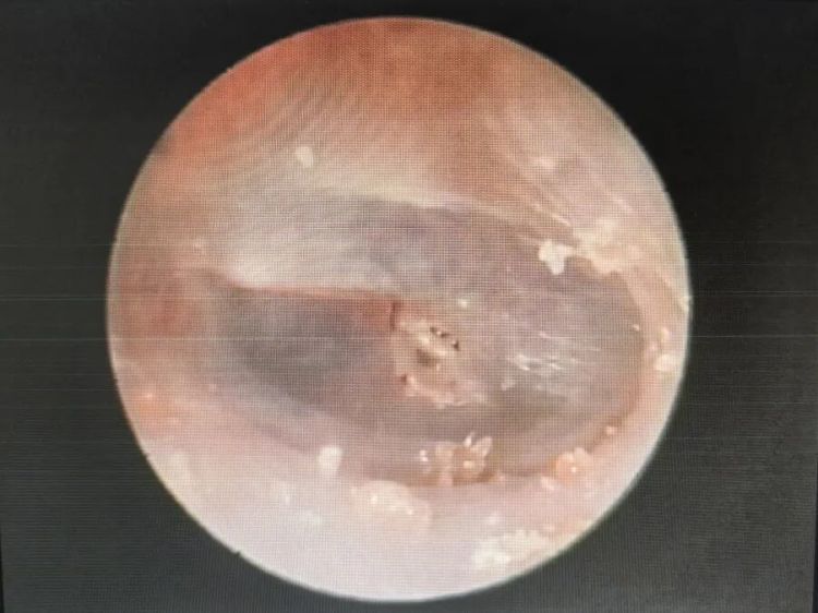 “我听不清声音了……”10岁孩子鼓膜穿孔，医生：这个动作很危险