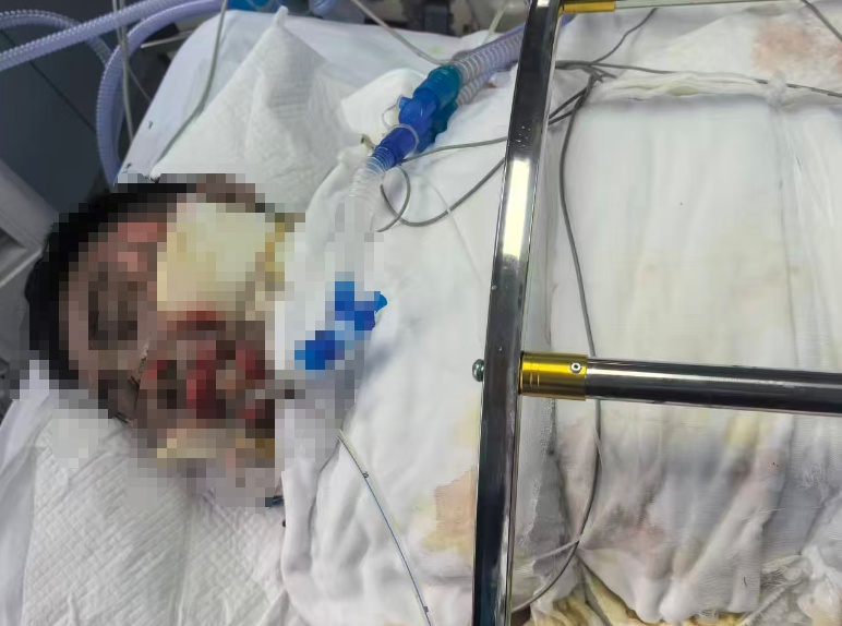 突然爆炸,女子全身95%皮肤重度烫伤!卫生间里的这些细节很多人忽视 突然爆炸,女子全身95%皮肤重度烫伤!卫生间里的这些细节很多人忽视