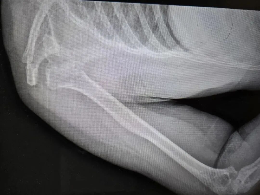 50岁女子在睡梦中,肩膀骨头竟碎成七八块!医生:第一反应不敢相信 50岁女子在睡梦中,肩膀骨头竟碎成七八块!医生:第一反应不敢相信