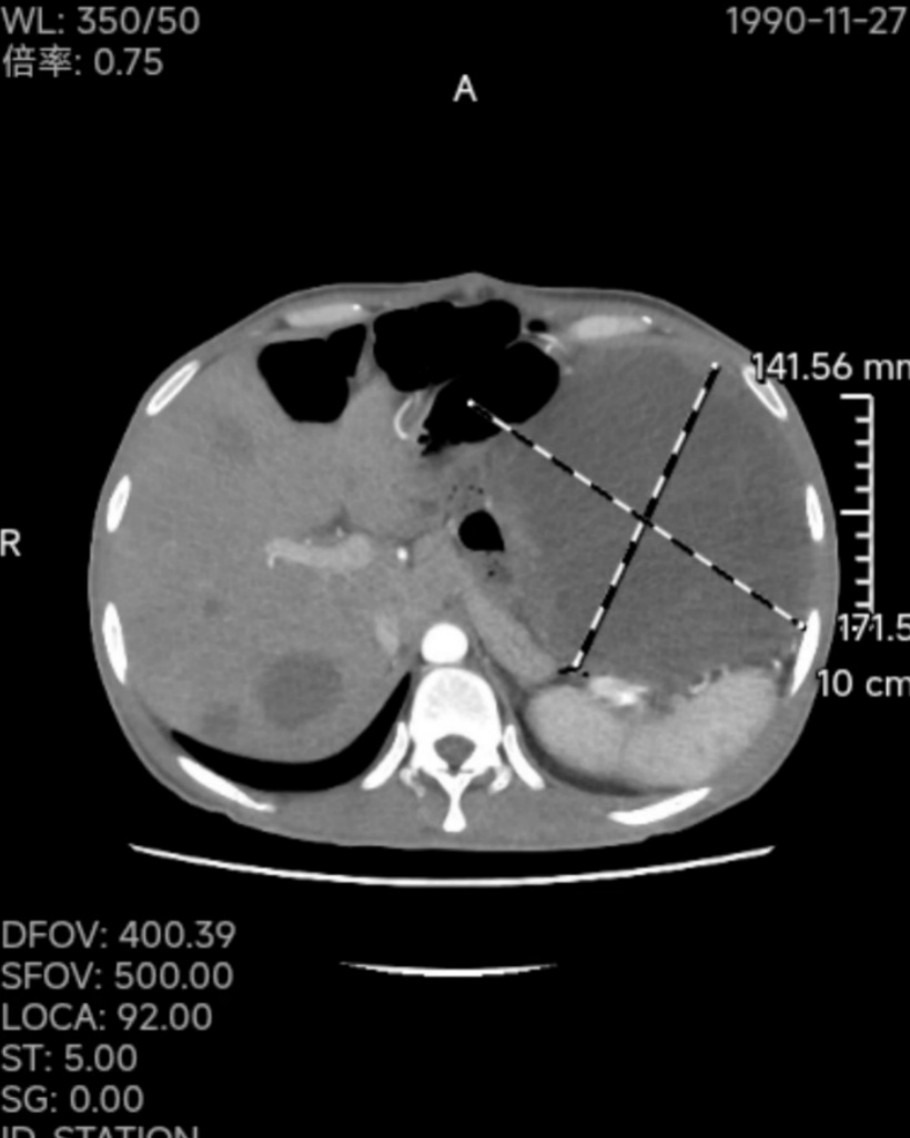 男子肚大如“怀孕”，赴佛山“卸货”20斤肿瘤！医生警告：药不能停！