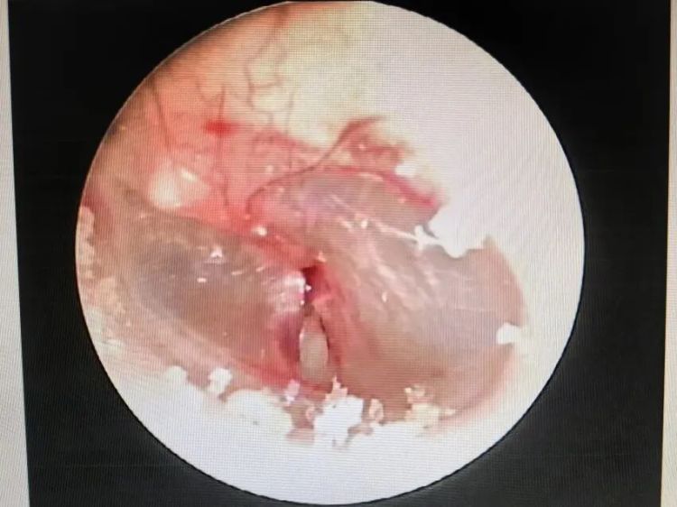 “我听不清声音了……”10岁孩子鼓膜穿孔，医生：这个动作很危险