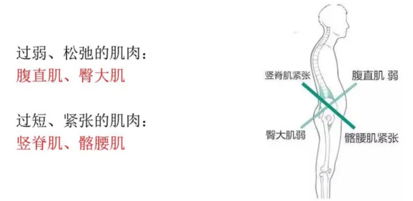 有的人看起来“前凸后翘” 其实是「骨盆前倾」了 有的人看起来“前凸后翘” 其实是「骨盆前倾」了