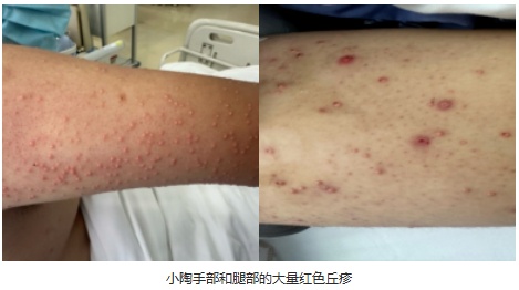 18岁少年血脂超标61倍，身上密密麻麻长满红色丘疹，连医生都震惊了……