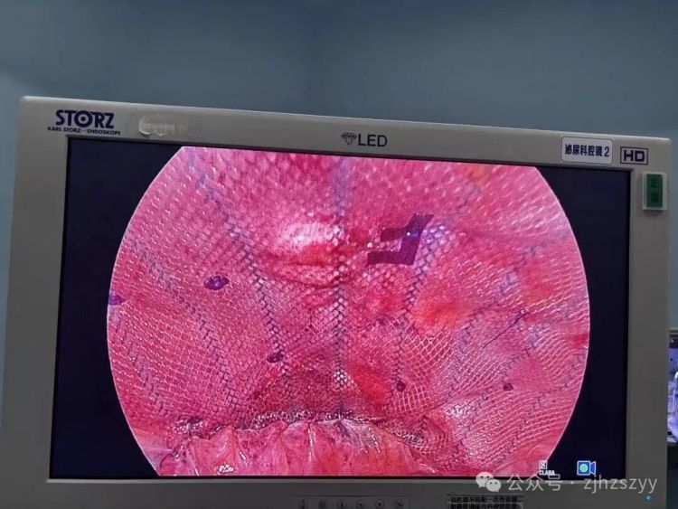 太可怕!杭州辣妈模仿明星,肚子练出“大洞”,医生紧急提醒 太可怕!杭州辣妈模仿明星,肚子练出“大洞”,医生紧急提醒